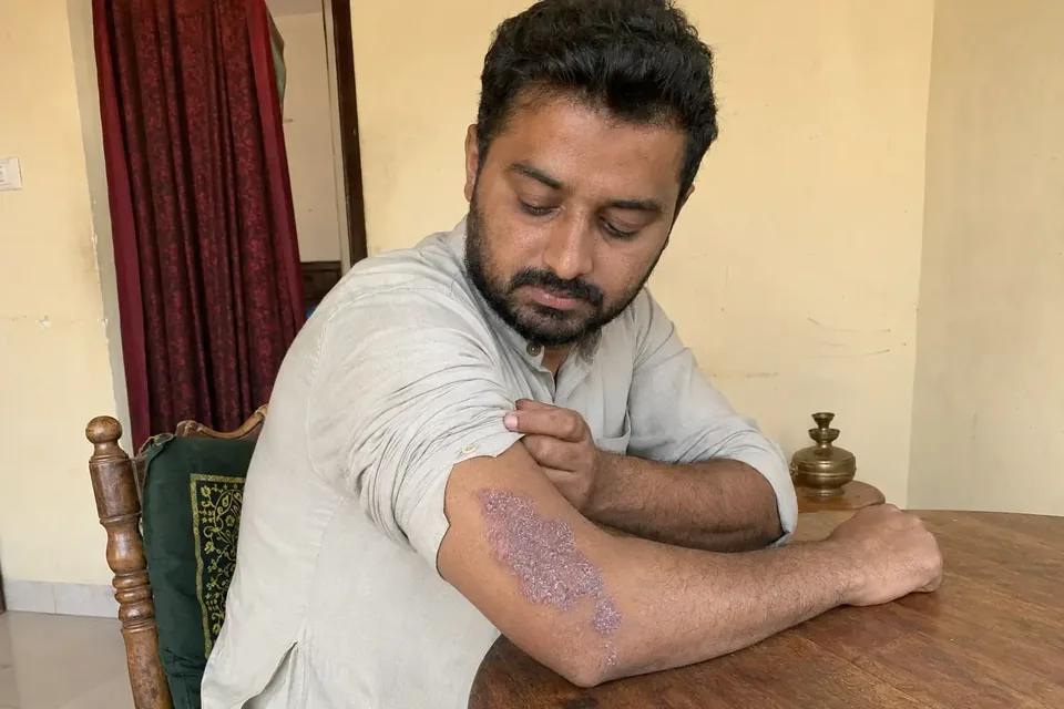Illustrative scene of an Indian man checking a recurring scaly skin patch on his arm.